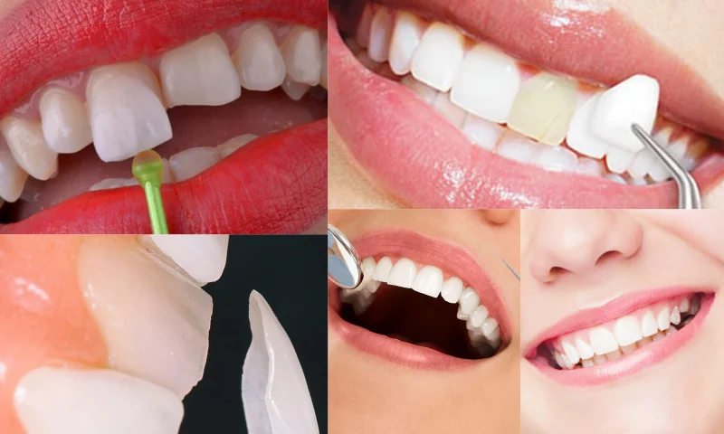 Ön Dişlerde Gülüş Estetiği Tedavileri 