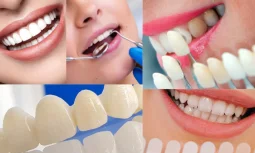 Zirconium Dental Vene