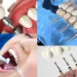 Diş İmplantı: Sağlıklı ve Estetik Bir Gülüş İçin İdeal Çözüm